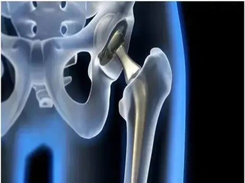 Titanyum Alaşımları İnsan Dokusuyla Nasıl Uyumlu Bir Şekilde Bir Arada Var Ol...